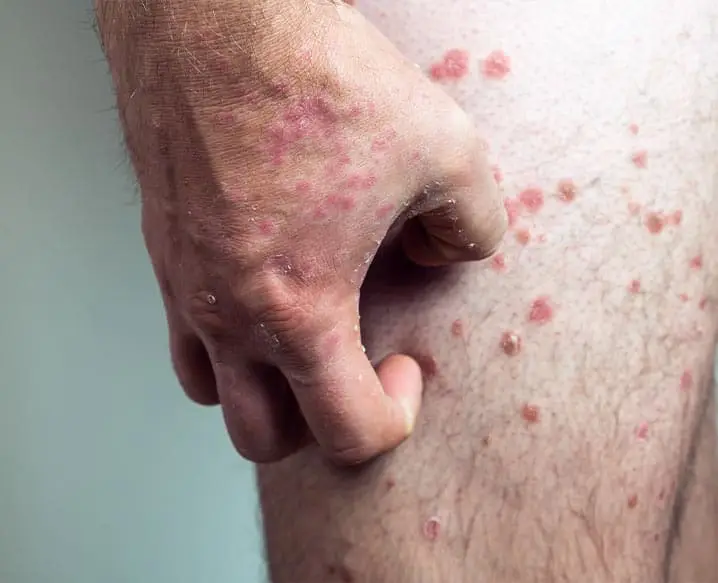 Psoriasis treatment in Delhi